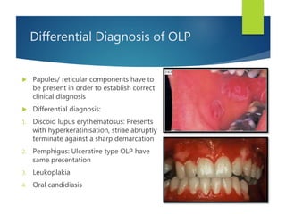 Differential Diagnosis of OLP
 Papules/ reticular components have to
be present in order to establish correct
clinical diagnosis
 Differential diagnosis:
1. Discoid lupus erythematosus: Presents
with hyperkeratinisation, striae abruptly
terminate against a sharp demarcation
2. Pemphigus: Ulcerative type OLP have
same presentation
3. Leukoplakia
4. Oral candidiasis
 