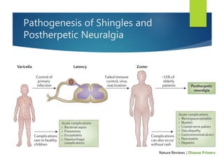 Pathogenesis of Shingles and
Postherpetic Neuralgia
 
