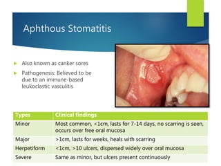 Aphthous Stomatitis
 Also known as canker sores
 Pathogenesis: Believed to be
due to an immune-based
leukoclastic vasculitis
Types Clinical findings
Minor Most common, <1cm, lasts for 7-14 days, no scarring is seen,
occurs over free oral mucosa
Major >1cm, lasts for weeks, heals with scarring
Herpetiform <1cm, >10 ulcers, dispersed widely over oral mucosa
Severe Same as minor, but ulcers present continuously
 