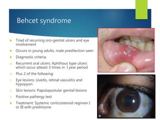 Behcet syndrome
 Triad of recurring oro-genital ulcers and eye
involvement
 Occurs in young adults, male predilection seen
 Diagnostic criteria:
a) Recurrent oral ulcers: Aphthous type ulcers
which occur atleast 3 times in I year period
b) Plus 2 of the following:
1. Eye lesions: Uveitis, retinal vasculitis and
hypopyon
2. Skin lesions: Papulopustular genital lesions
3. Positive pathergy test
 Treatment: Systemic corticosteroid regimen I
or III with prednisone
 