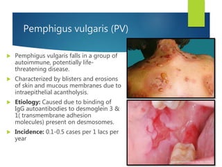 Pemphigus vulgaris (PV)
 Pemphigus vulgaris falls in a group of
autoimmune, potentially life-
threatening disease.
 Characterized by blisters and erosions
of skin and mucous membranes due to
intraepithelial acantholysis.
 Etiology: Caused due to binding of
IgG autoantibodies to desmoglein 3 &
1( transmembrane adhesion
molecules) present on desmosomes.
 Incidence: 0.1-0.5 cases per 1 lacs per
year
 