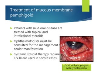 Treatment of mucous membrane
pemphigoid
 Patients with mild oral disease are
treated with topical and
intralesional steroids
 Ophthalmologists must be
consulted for the management of
ocular manifestation
 Systemic steroid therapy regimen
I & III are used in severe cases
Cicatricial pemphigoid
with symblepheron
 