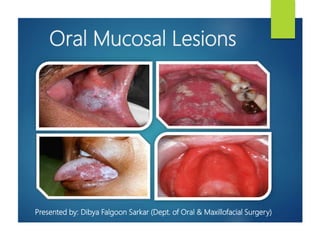 Oral Mucosal Lesions
Presented by: Dibya Falgoon Sarkar (Dept. of Oral & Maxillofacial Surgery)
 