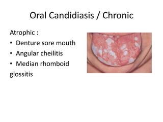 Oral mucosal ulceration | PPTX