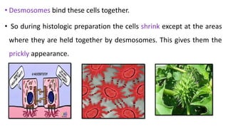 • Desmosomes bind these cells together.
• So during histologic preparation the cells shrink except at the areas
where they are held together by desmosomes. This gives them the
prickly appearance.
 