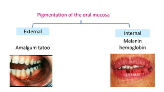 Pigmentation of the oral mucosa
External Internal
Amalgum tatoo
Melanin
hemoglobin
 