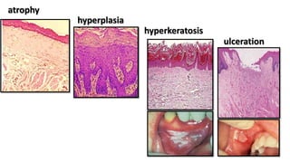 atrophy
hyperplasia
hyperkeratosis
ulceration
 