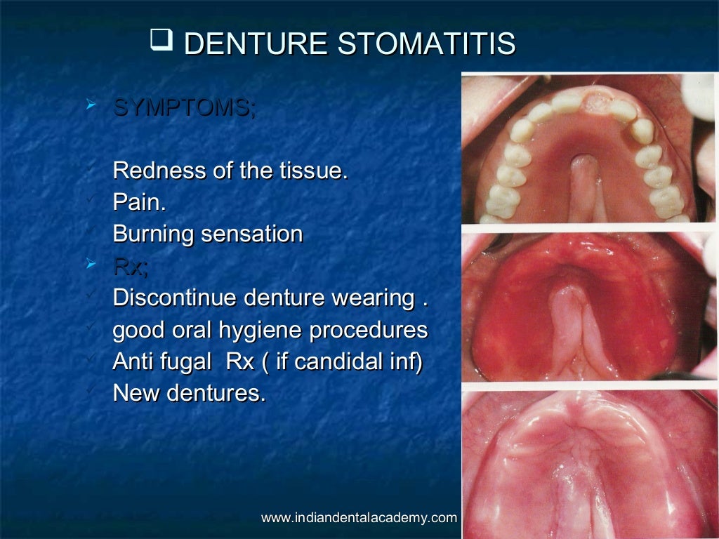Oral mucous membrane /certified fixed orthodontic courses by Indian d…