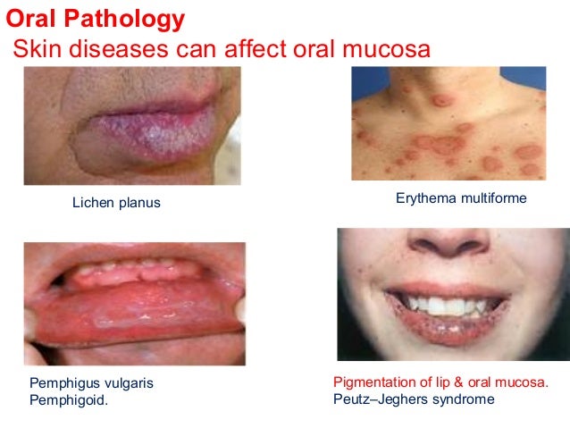 oral pathology Oral pathology clinical review 4 credit hours (4 ces) materials from united states air force 2013 instructional materials in the public domain for dental professionals. oral pathology Oral pathology clinical review 4 credit hours (4 ces) materials from united states air force 2013 instructional materials in the public domain for dental professionals.