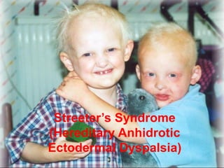 Streeter’s Syndrome
(Hereditary Anhidrotic
Ectodermal Dyspalsia)
 