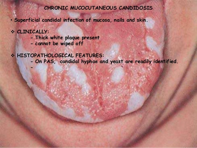 Oral pathology ... fungal infections 2