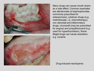 Many drugs can cause mouth ulcers
as a side effect. Common examples
are alendronate (a bisphosphonate,
commonly prescribed for
osteoporosis), cytotoxic drugs (e.g.
methotrexate, i.e. chemotherapy),
non steroidal anti-inflammatory
drugs, nicorandil (may be prescribed
for angina) and propylthiouracil (e.g.
used for hyperthyroidism). Some
illegal drugs can cause ulceration,
e.g. cocaine
Drug-induced neutropenia
 
