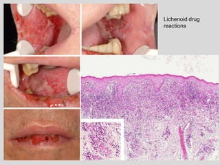 Lichenoid drug
reactions
 