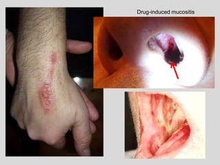 Drug-induced mucositis
 