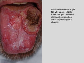 Advanced oral cancer (T4
N2 M0, stage 4). Note
rolled margins of central
ulcer and surrounding
areas of premalignant
change.
 