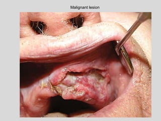 Malignant lesion
 