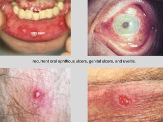 recurrent oral aphthous ulcers, genital ulcers, and uveitis.
 