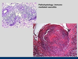 Pathohystology: immune-
mediated vasculitis
 