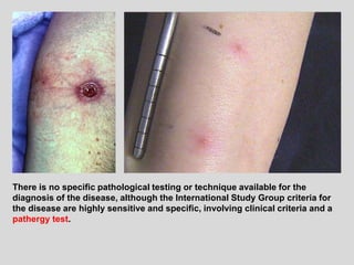 There is no specific pathological testing or technique available for the
diagnosis of the disease, although the International Study Group criteria for
the disease are highly sensitive and specific, involving clinical criteria and a
pathergy test.
 