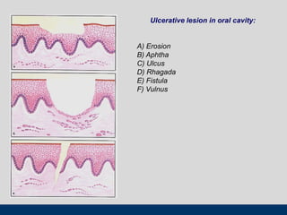 Ulcerative lesion in oral cavity:
А) Erosion
B) Aphtha
C) Ulcus
D) Rhagada
E) Fistula
F) Vulnus
 