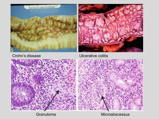 Crohn’s disease Ulcerative colitis
Granuloma Microabscessus
 