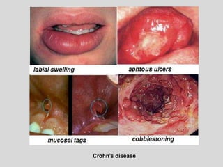 Crohn’s disease
 