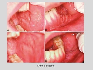 Crohn’s disease
 