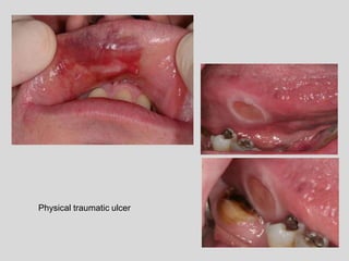 Physical traumatic ulcer
 