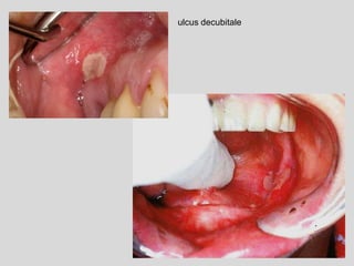 ulcus decubitale
 