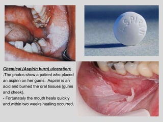 Chemical (Aspirin burn) ulceration:
-The photos show a patient who placed
an aspirin on her gums. Aspirin is an
acid and burned the oral tissues (gums
and cheek).
- Fortunately the mouth heals quickly
and within two weeks healing occurred.
 