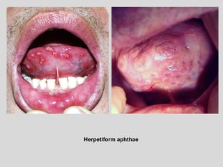 Herpetiform aphthae
 