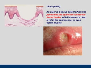 Ulcus (ulcer)
An ulcer is a tissue defect which has
penetrated the epithelial-connective
tissue border, with its base at a deep
level in the submucosa, or even
within muscle
 