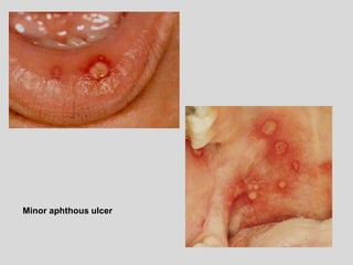 Minor aphthous ulcer
 