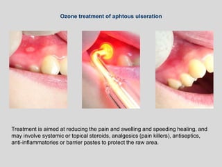 Ozone treatment of aphtous ulseration
Treatment is aimed at reducing the pain and swelling and speeding healing, and
may involve systemic or topical steroids, analgesics (pain killers), antiseptics,
anti-inflammatories or barrier pastes to protect the raw area.
 