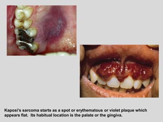 Kaposi’s sarcoma starts as a spot or erythematous or violet plaque which
appears flat. Its habitual location is the palate or the gingiva.
 