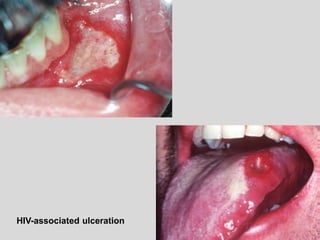HIV-associated ulceration
 