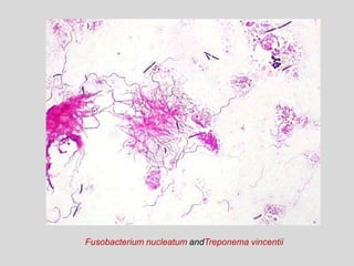 Fusobacterium nucleatum andTreponema vincentii
 