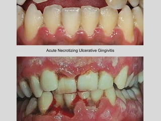 Acute Necrotizing Ulcerative Gingivitis
 