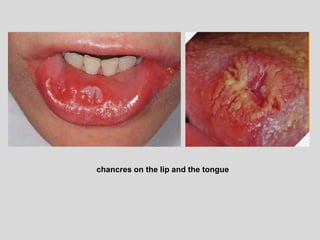 chancres on the lip and the tongue
 
