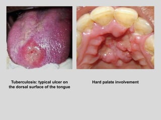 Tuberculosis: typical ulcer on
the dorsal surface of the tongue
Hard palate involvement
 