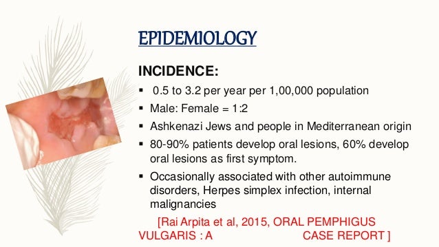 herpes test oral for pemphigus Oral vulgaris herpes test oral for pemphigus Oral vulgaris