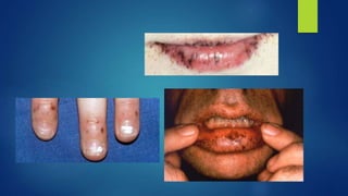 Oral pigmentation.pptx