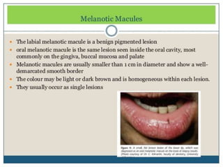 Oral pigmentation 2 | PPTX