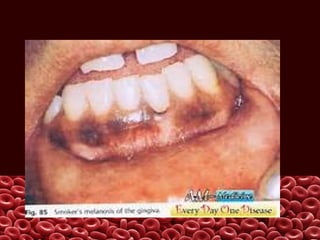 Oral pigmentation lesion
