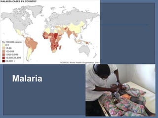 Malaria