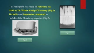 This radiograph was made on February 1st,
1896 by Dr. Walter Konig of Germany (Fig.1).
Dr Kells used impression compound to
stabilized the film during exposure (Fig.2).
Fig.2
Fig.1
 