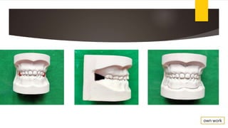 Tooth Screen ORAL SCREEN in ortho patients- a case report | PPTX