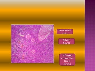 Keratinized
cells
Mitotic
figures

Inflamed
connective
tissue
stroma

 