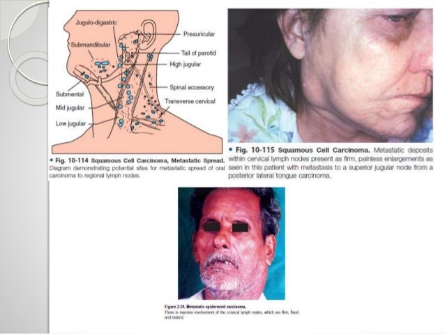 Oral Squamous Cell Carcinoma