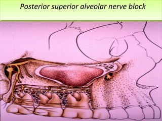 www.themegallery.com
Posterior superior alveolar nerve blockPosterior superior alveolar nerve block
 